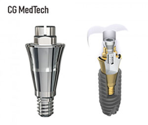 디지털 임플란트 혁신 '우루덴트 SA' 소개